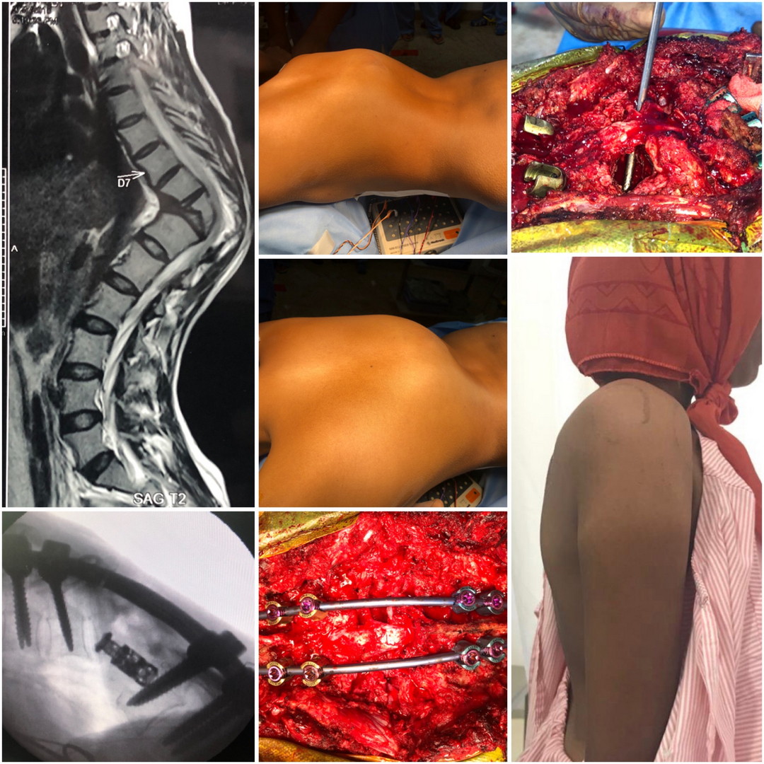 Correction of Kyphosis 