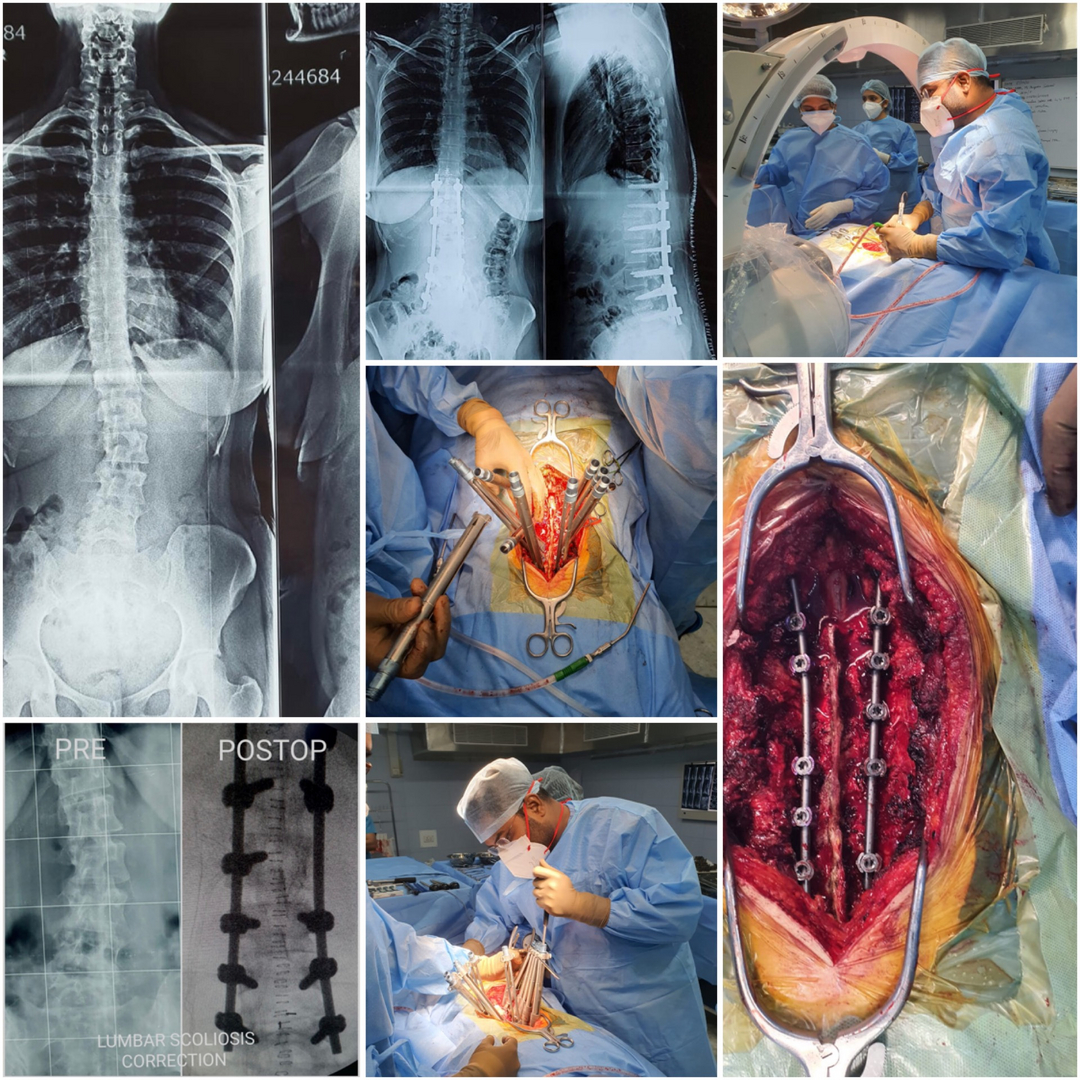Scoliosis Correction