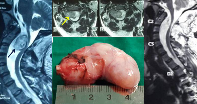 Spinal tumour