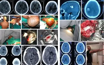 Awake brain tumor surgeries loading=