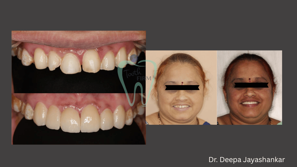 Smile Designing loading=