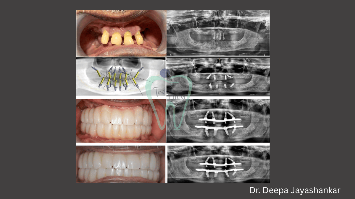 Implant Supported Denture loading=