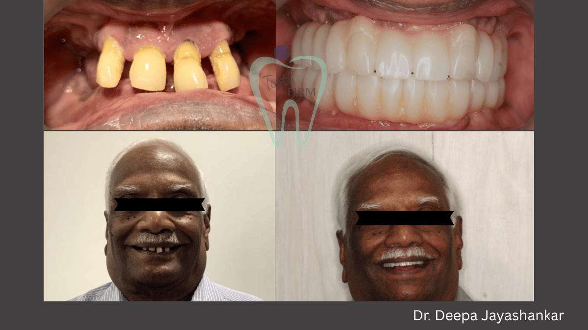 Implant Supported Denture loading=