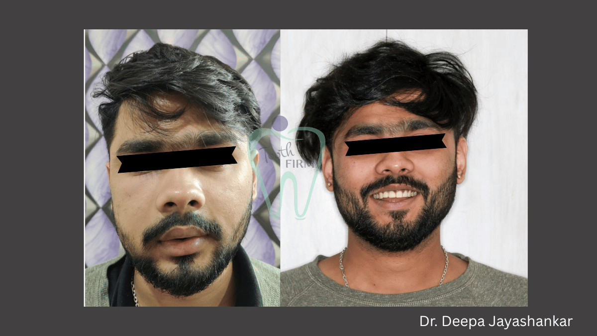  Missing Tooth Replacement with Dental Implant loading=