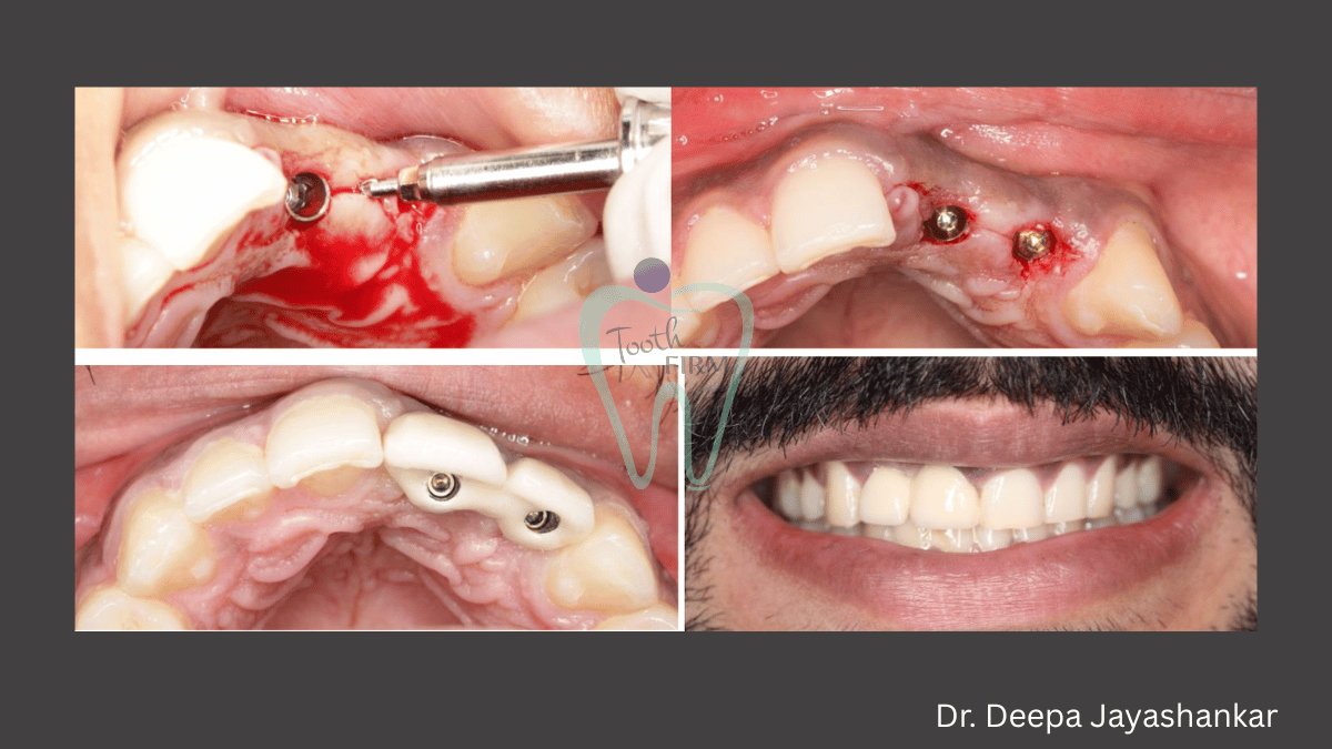  Missing Tooth Replacement with Dental Implant loading=