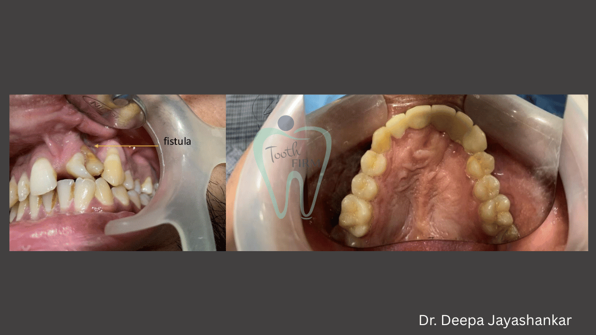 Cleft Lip and Pallet Rehabilitation loading=