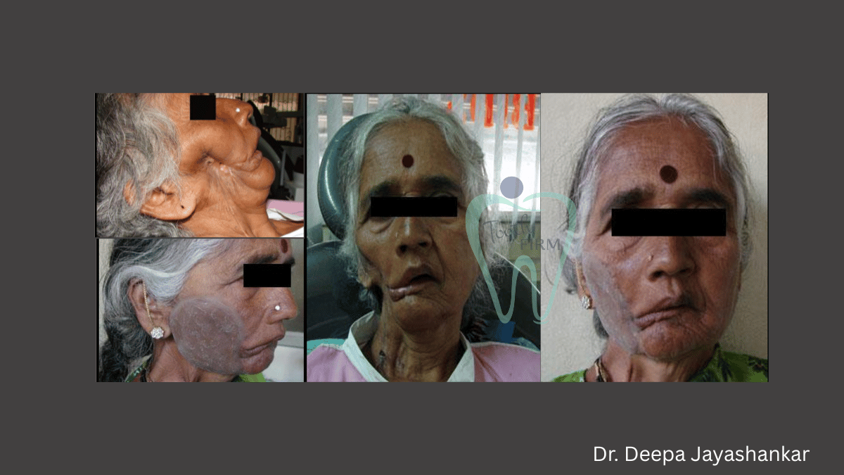 Maxillofacial Prosthesis post Cancer loading=