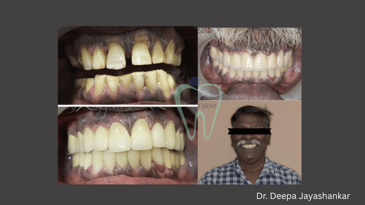 Full Mouth Rehabilitation with Smile Designing  loading=