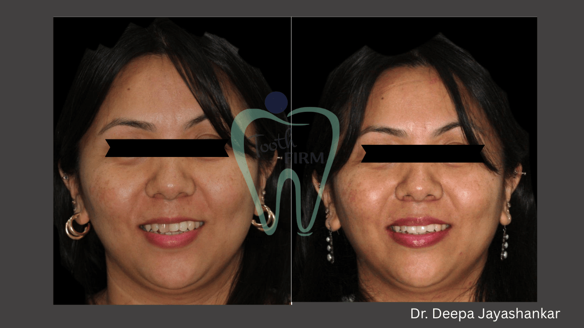 Smile Designing  loading=