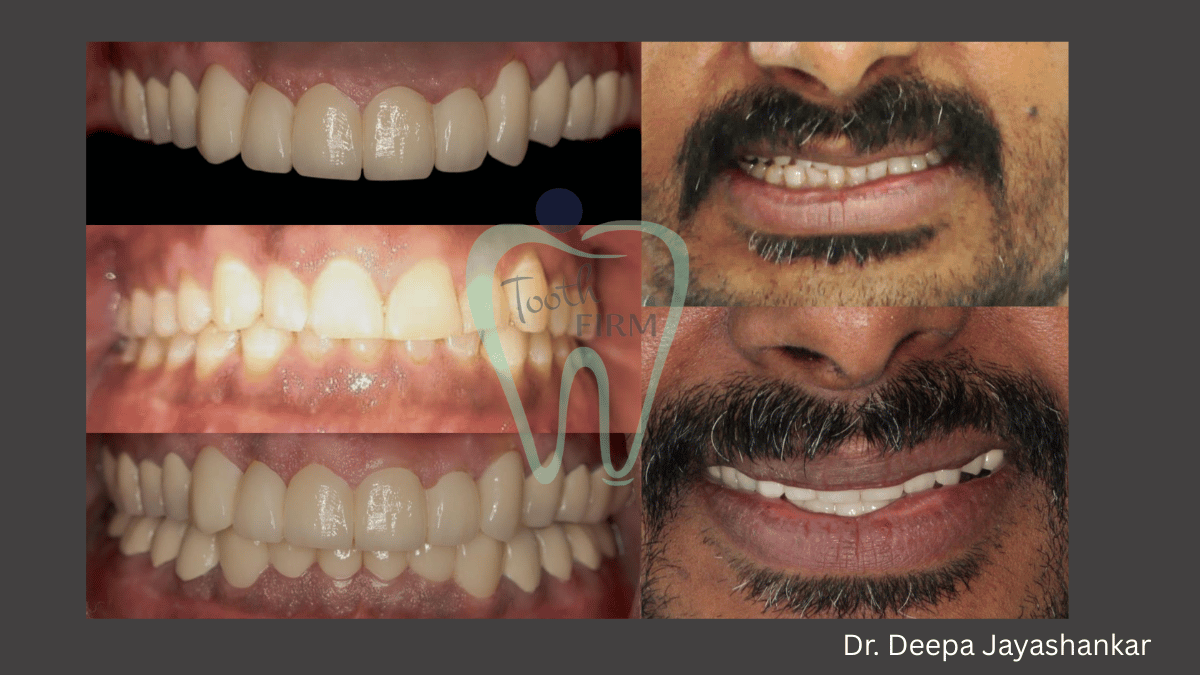 Full Mouth Rehabilitation loading=