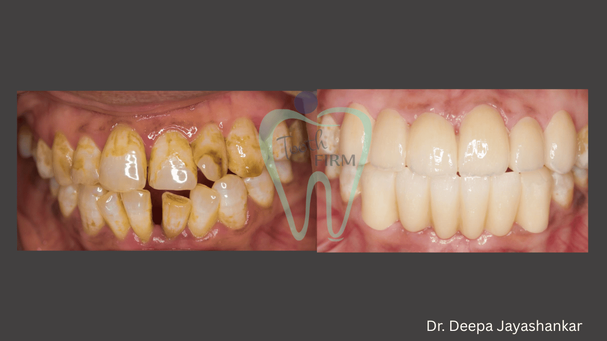 Smile Designing loading=