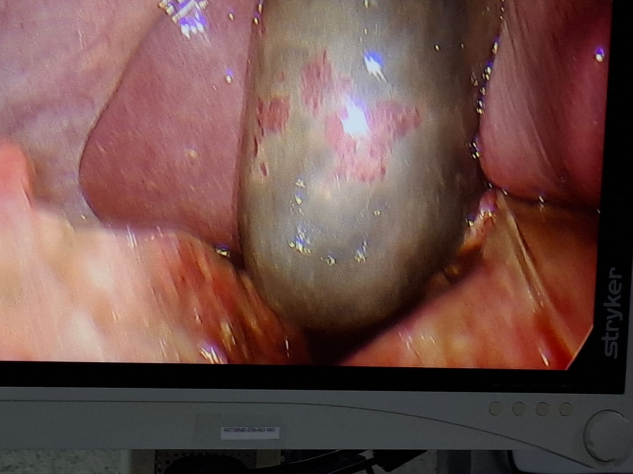 Case operated by Dr. Anupama Pujar, Laparoscopic cholecystectomy for gangrenous cholecystitis loading=