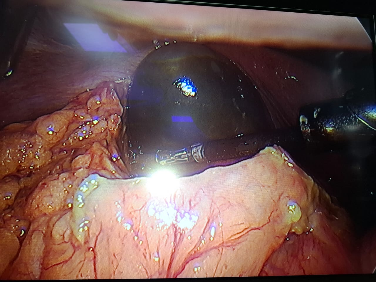 Case operated by Dr. Anupama Pujar, Laparoscopic cholecystectomy for gangrenous cholecystitis loading=