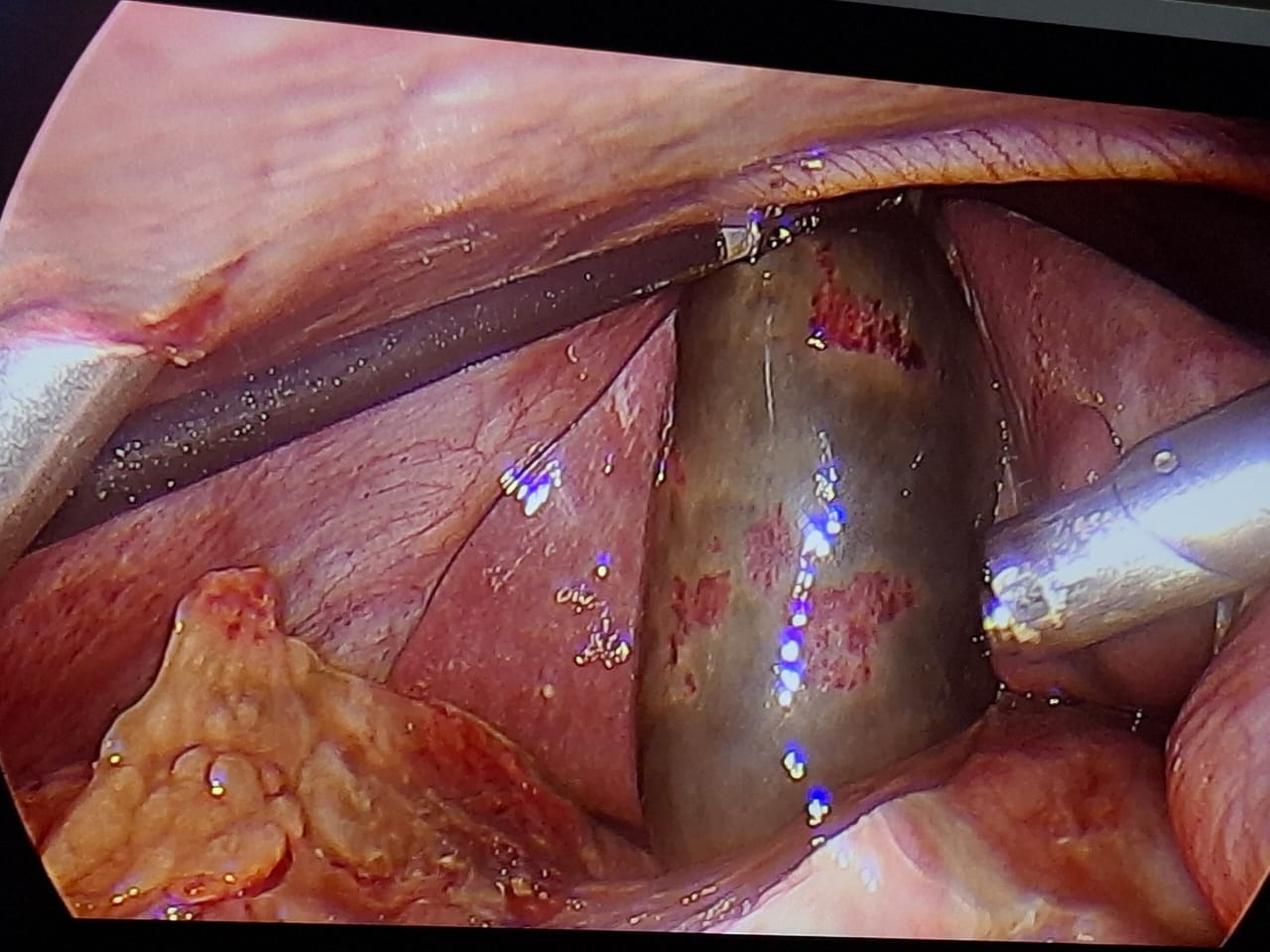 Case operated by Dr. Anupama Pujar, Laparoscopic cholecystectomy for gangrenous cholecystitis loading=