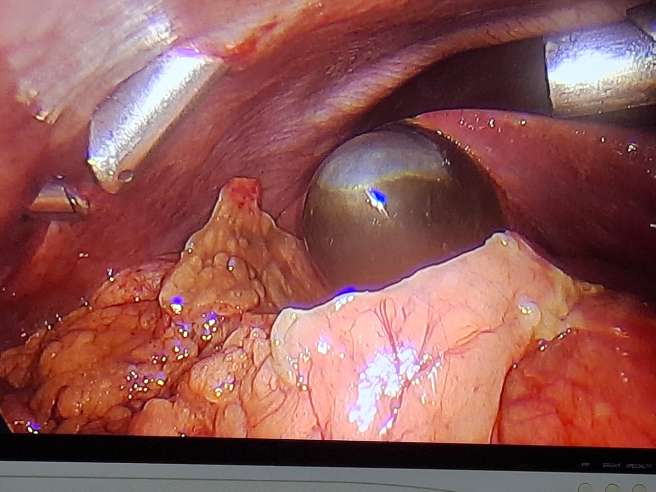 Case operated by Dr. Anupama Pujar, Laparoscopic cholecystectomy for gangrenous cholecystitis loading=
