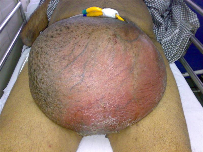 Large Inguinoscrotal Hernia