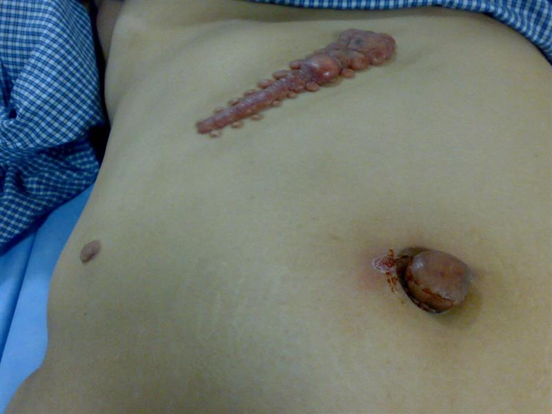 Patient with Keloid scar
