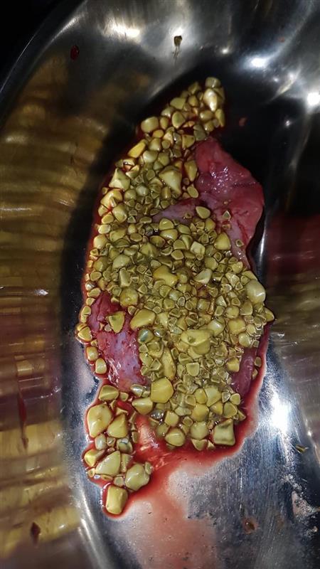 Gall bladder stones removed