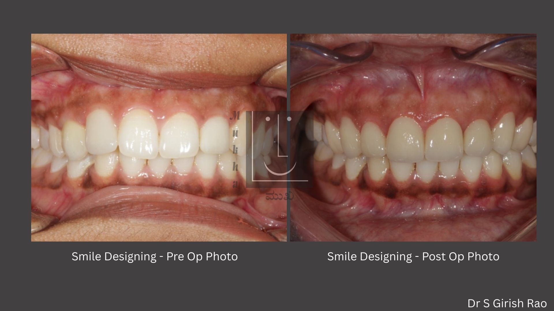 Smile designing- Pre and Post OP