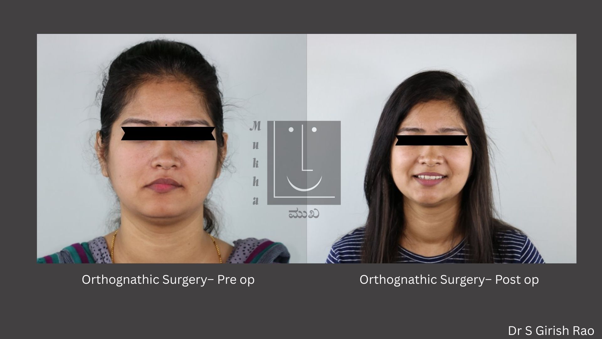 Orthognathic surgery Pre and Post OP
