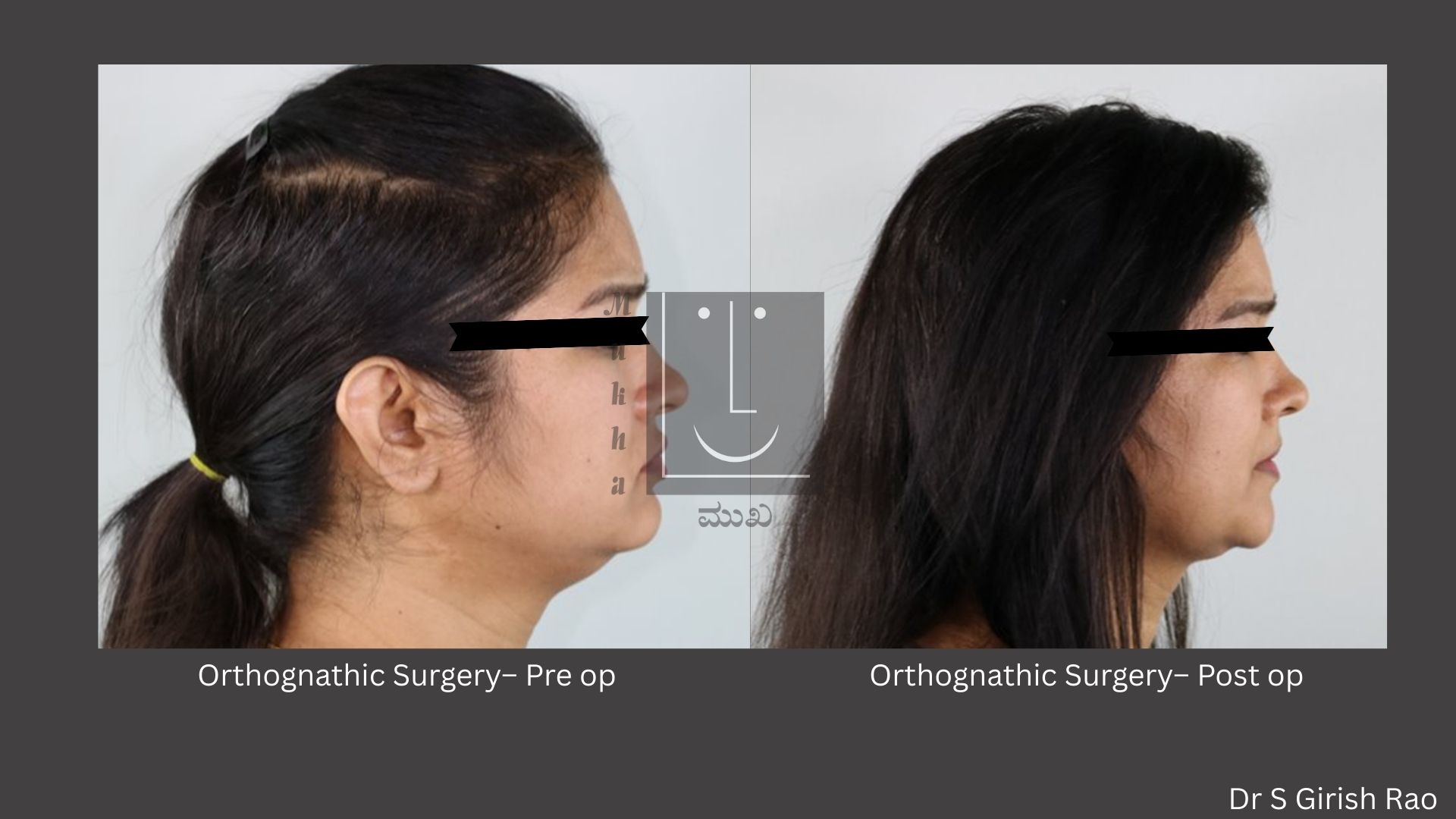 Orthognathic surgery Pre and Post OP