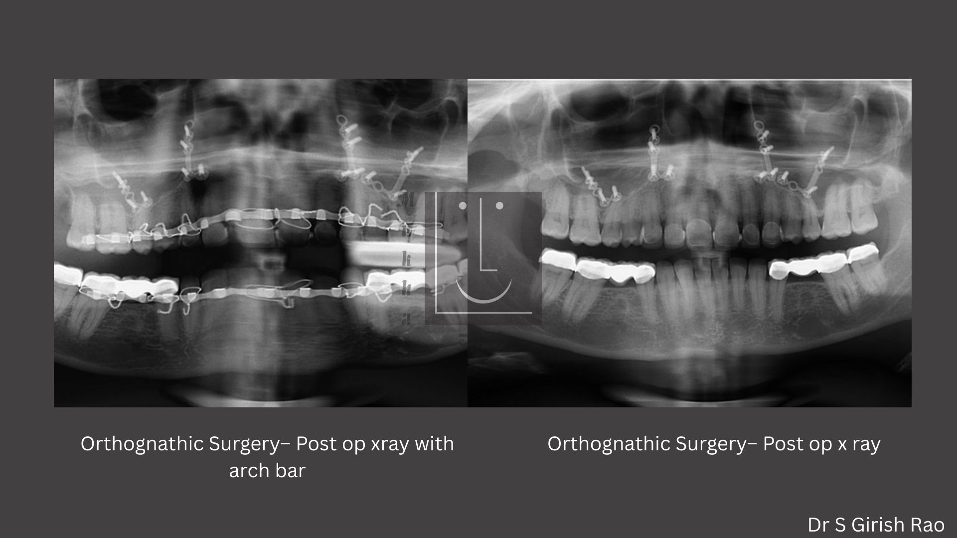 X-ray of Orthognathic surgery Pre and Post OP