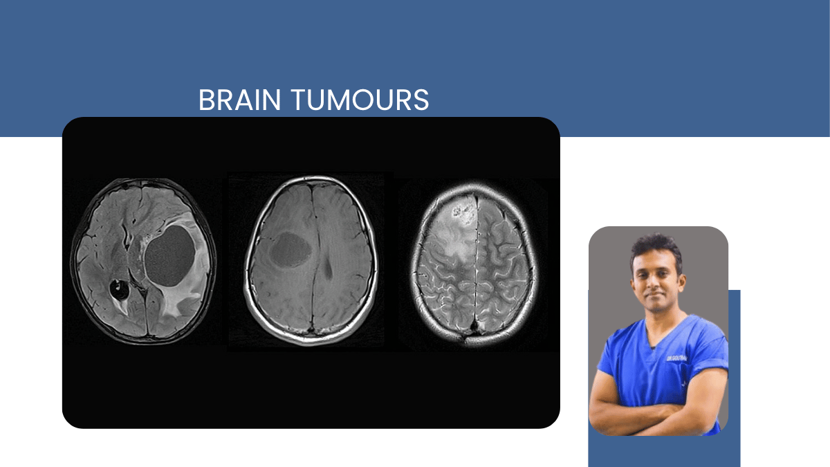 Brain Tumours