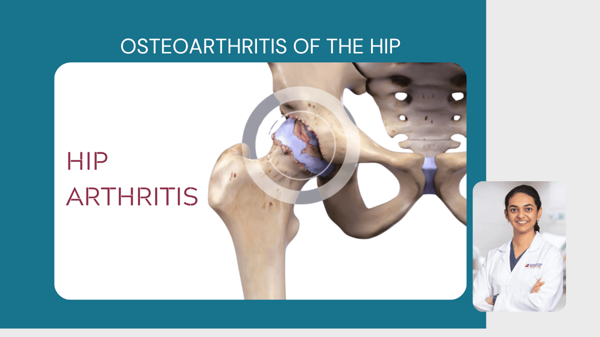 Osteoarthritis of the Hip 
