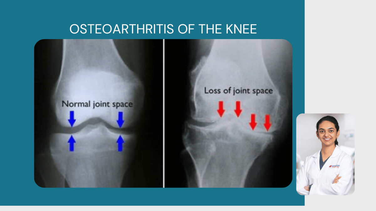 Osteoarthritis of the Knee 