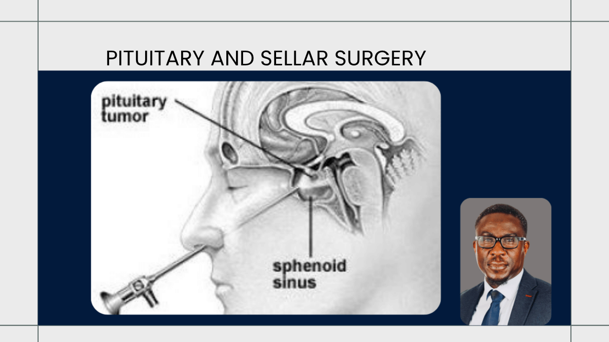 Pituitary and Sellar Surgery