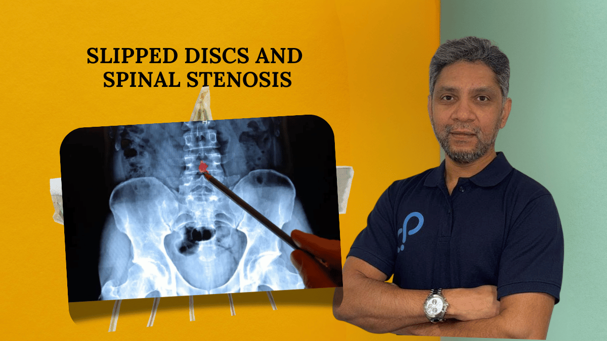 Slipped Discs and Spinal Stenosis 