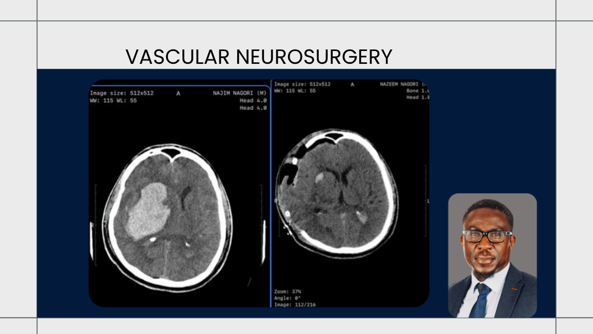 Vascular Neurosurgery