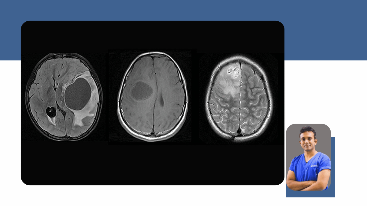 Brain Tumours