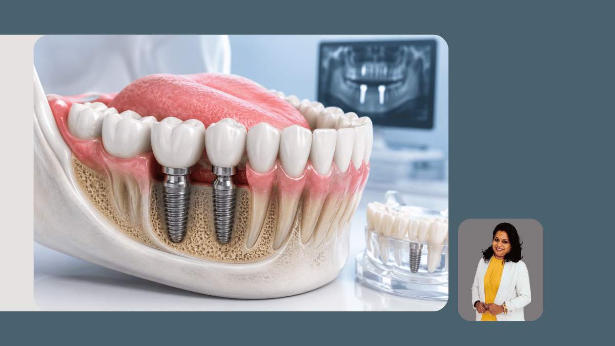 Dental Implants