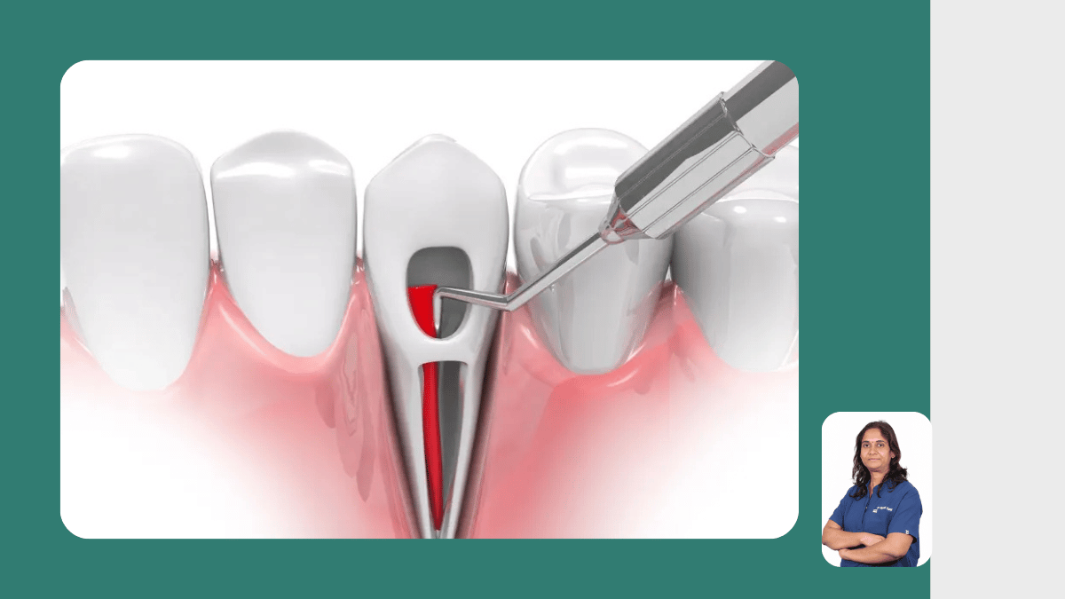  Failed Root Canal Retreatment