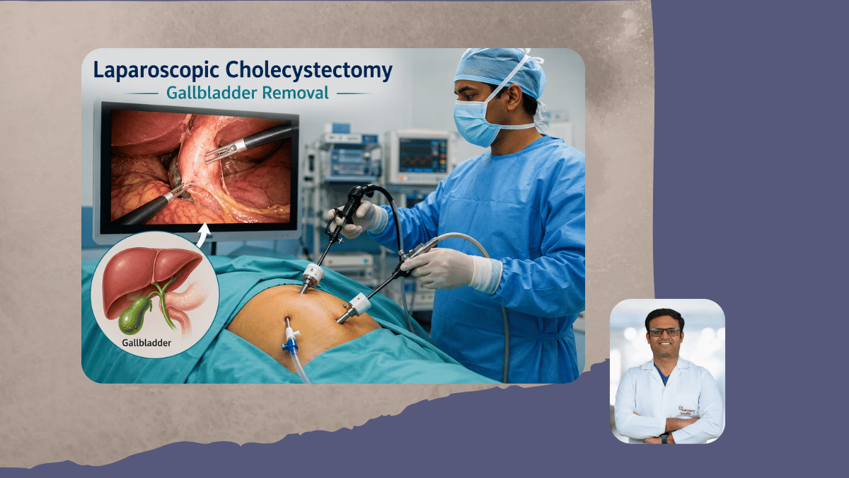 Laparoscopic Cholecystectomy - Gallbladder Removal