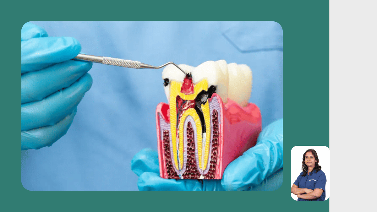  Root Canal Treatment (RCT)