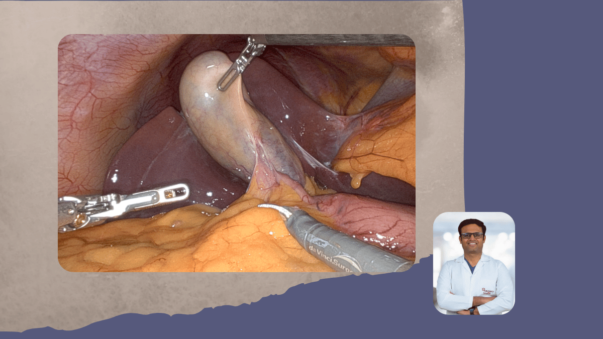 Gallbladder Disease and Complex Biliary Surgery: When Specialist Hepatobiliary Expertise Changes the Outcome