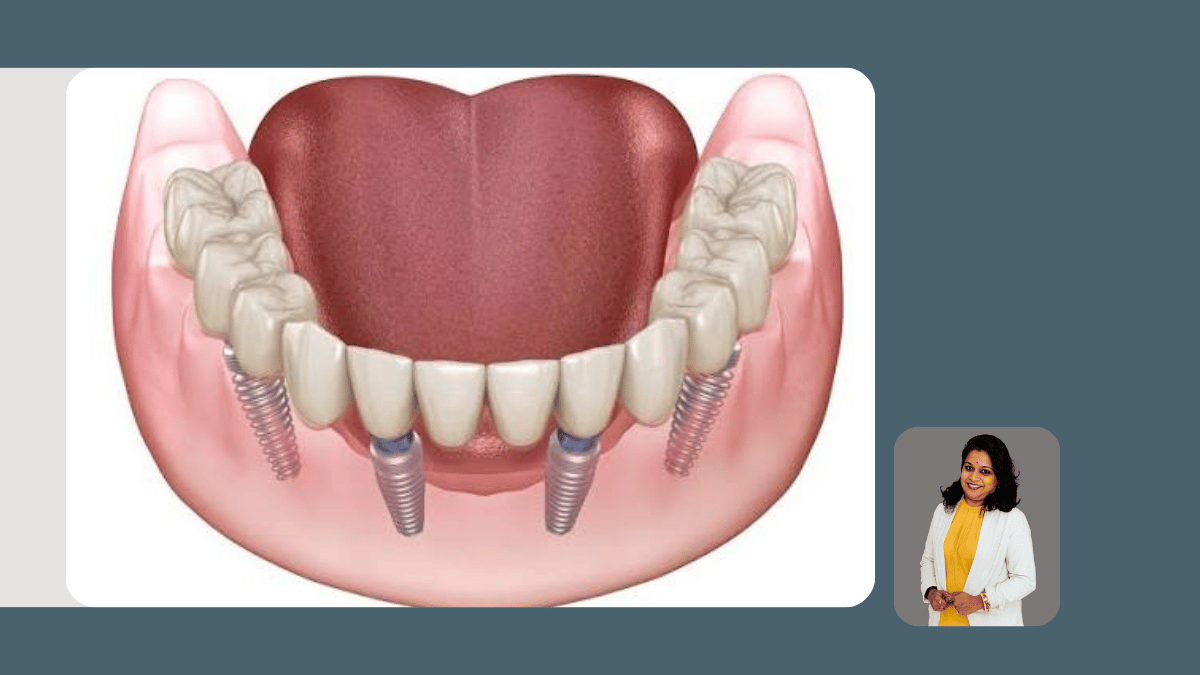 Severe Tooth Wear and Bite Rehabilitation: When the Whole Bite Needs to Be Rebuilt