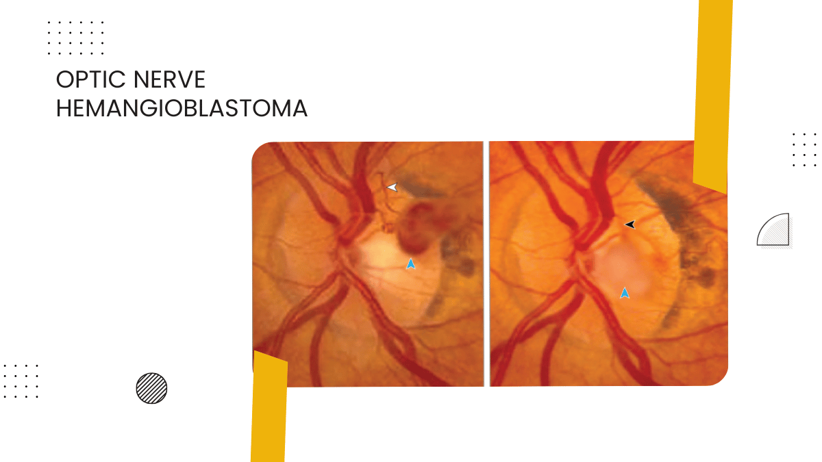 Optic Nerve Hemangioblastoma