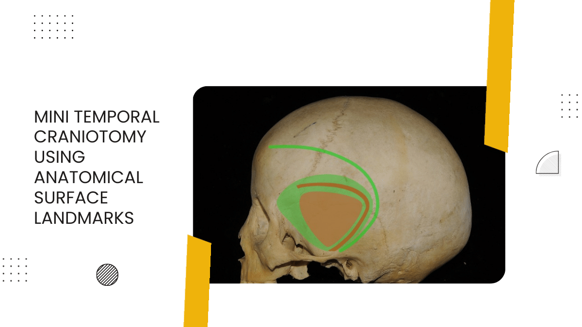 Mini Temporal Craniotomy Using Anatomical Surface Landmarks