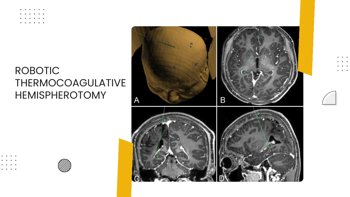 Robotic Thermocoagulative Hemispherotomy