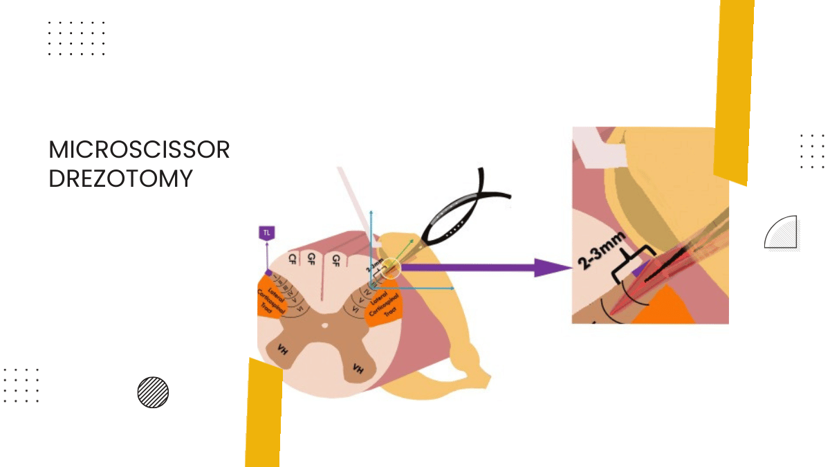 Microscissor DREZotomy for Post-Brachial Plexus Avulsion Neuralgia