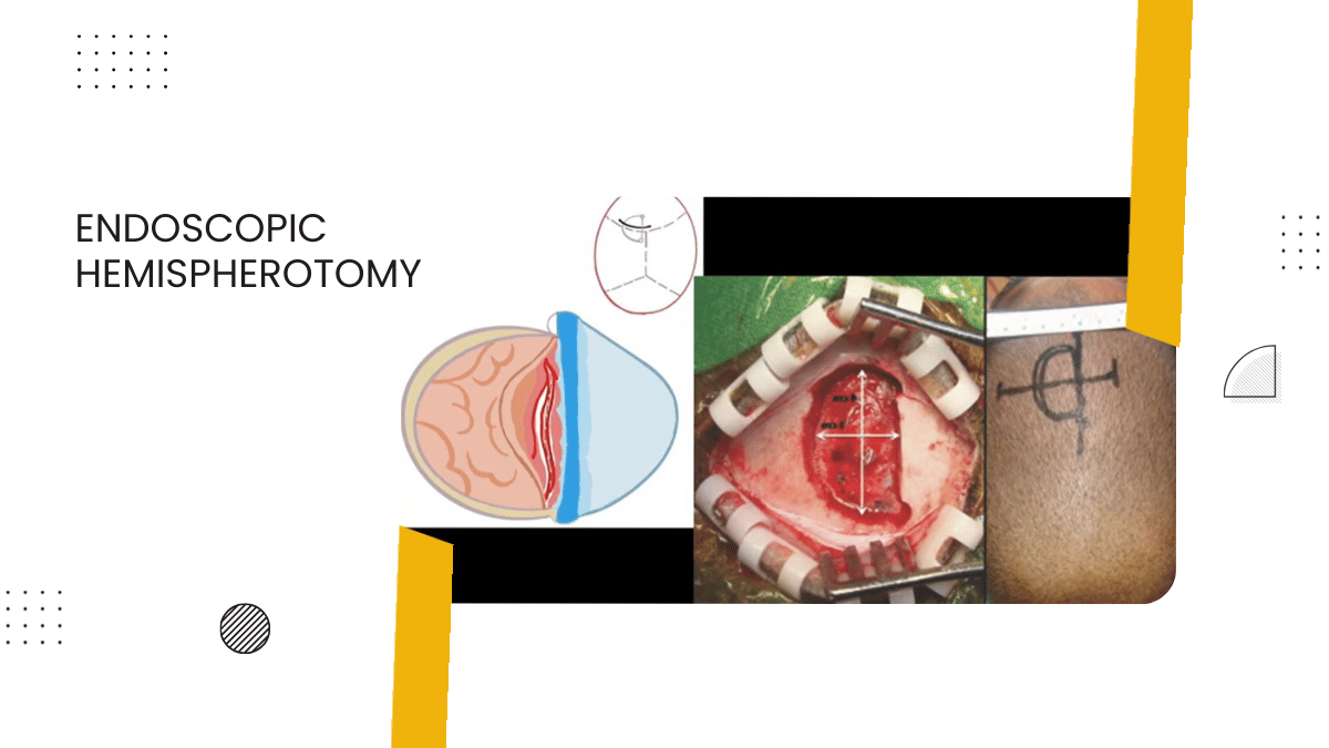 Endoscopic Hemispherotomy for Nonatrophic Rasmussen's Encephalopathy