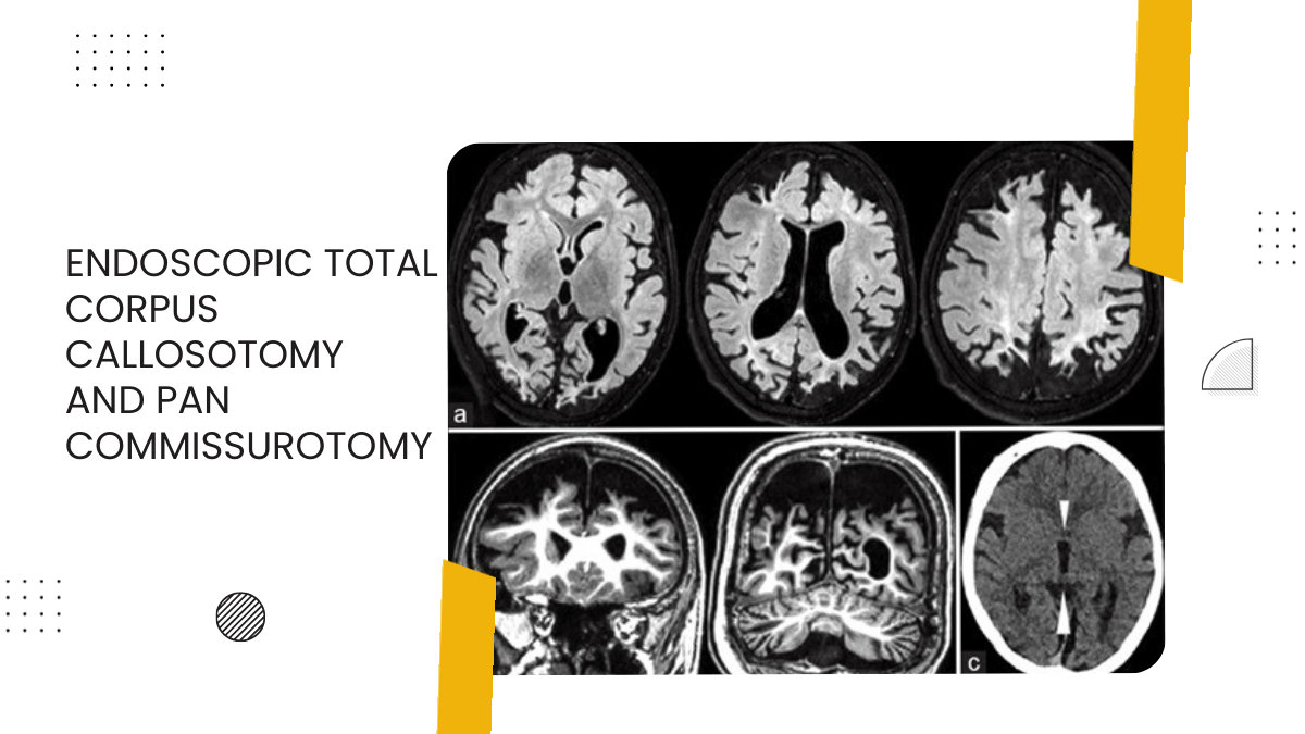 Endoscopic Total Corpus Callosotomy and Pan Commissurotomy