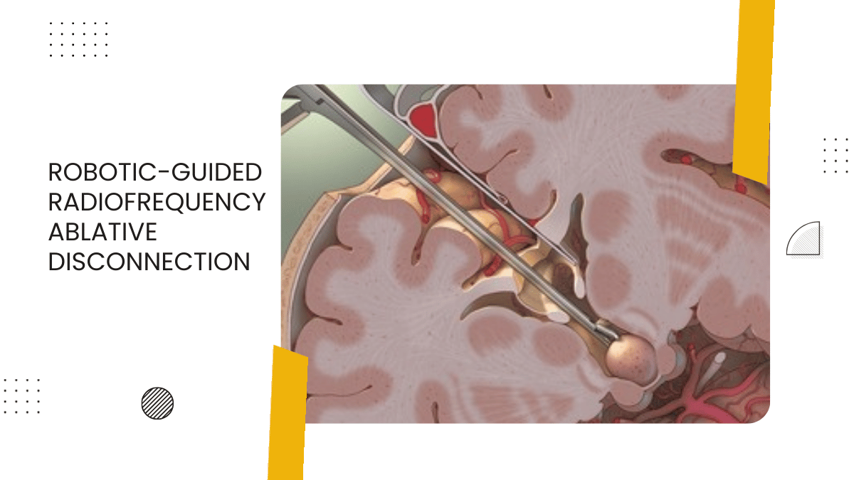 Robotic-Guided Radiofrequency Ablative Disconnection of Hypothalamic Hamartoma