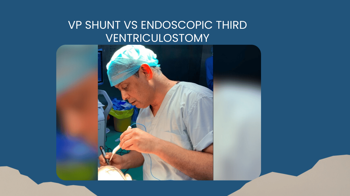 VP Shunt vs Endoscopic Third Ventriculostomy: How We Treat Hydrocephalus Today