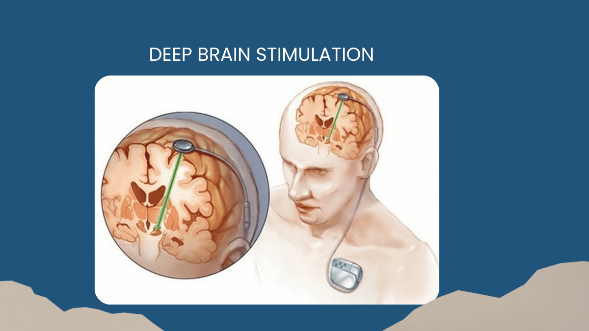 Deep Brain Stimulation  A Life Changing Option for Parkinson’s Patients