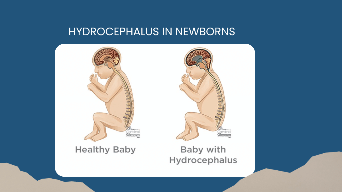 Hydrocephalus in Newborns Can It Be Detected Before Birth