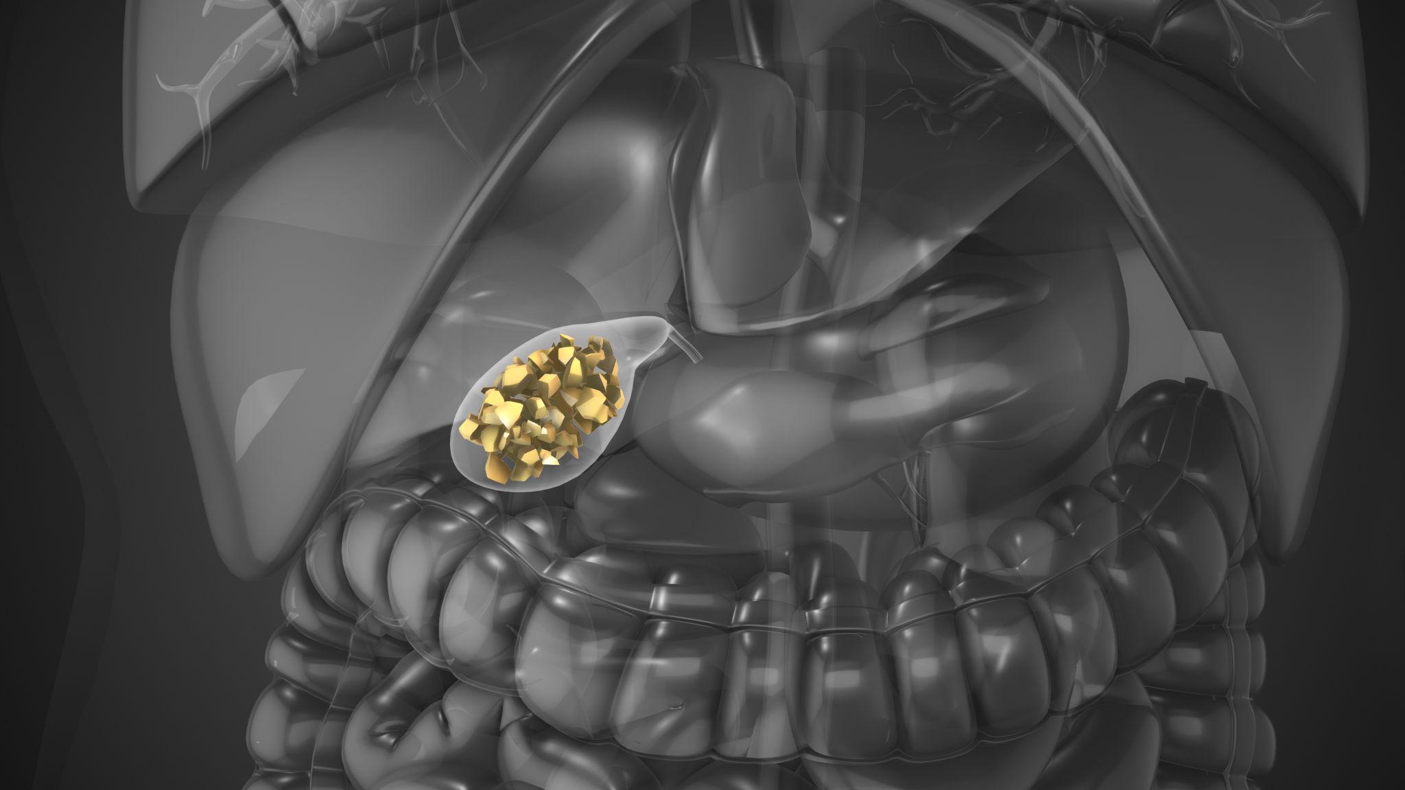 Gallstones: When Do You Really Need Surgery?